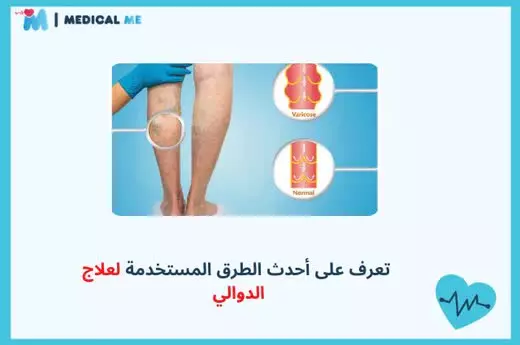 Treatment of varicose veins 12 Treatment of varicose veins