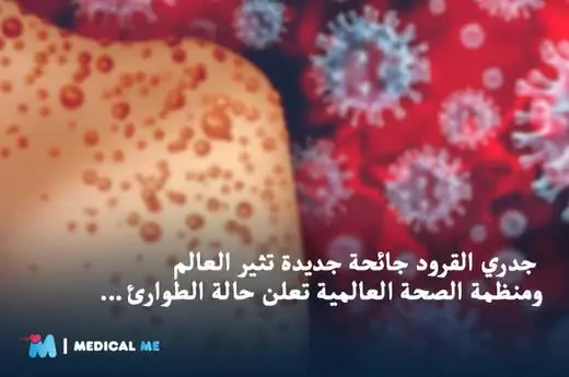 Home 3 Monkeypox Virus